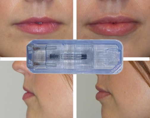 CE Injectable Enchevêtrement de remplissage d'acide hyaluronique Lip Injection 24mg/ml