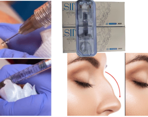 Acide hyaluronique pour injection sur le visage et les lèvres