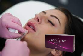 Acide hyaluronique croisé pour femme, remplisseur cutané, Juvederm, remplisseur de lèvres Ultra 3 Ultra 4