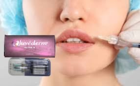 1 ml / boîte Remplisseurs pour lèvres injectables