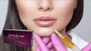 Juvederm Ultra 3 Acide hyaluronique HA Remplisseur cutané 2 ml Amélioration des lèvres