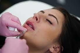 GMP Juvederm Ultra 3 HA Remplisseur cutané pour les lèvres Juvederm Vollure